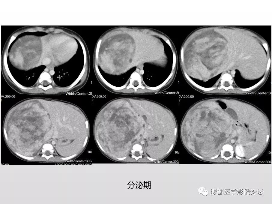 【病例】肾透明细胞肉瘤1例影像表现