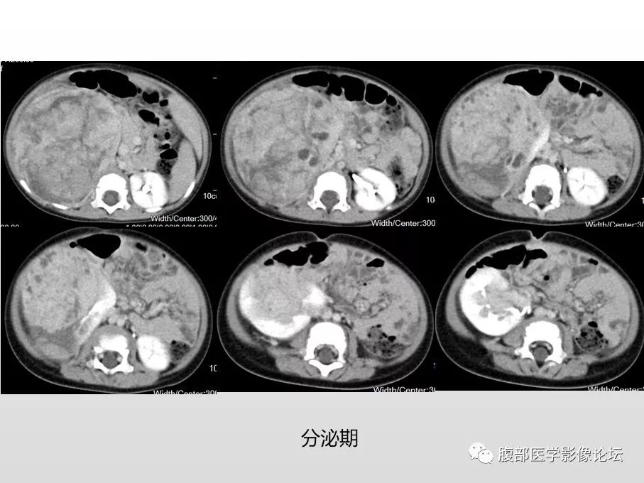 【病例】肾透明细胞肉瘤1例影像表现