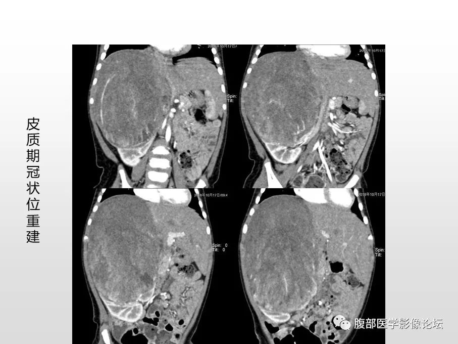 【病例】肾透明细胞肉瘤1例影像表现