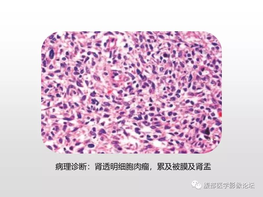 【病例】肾透明细胞肉瘤1例影像表现