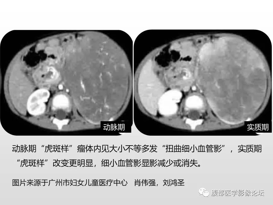 【病例】肾透明细胞肉瘤1例影像表现