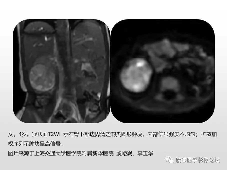 【病例】肾透明细胞肉瘤1例影像表现