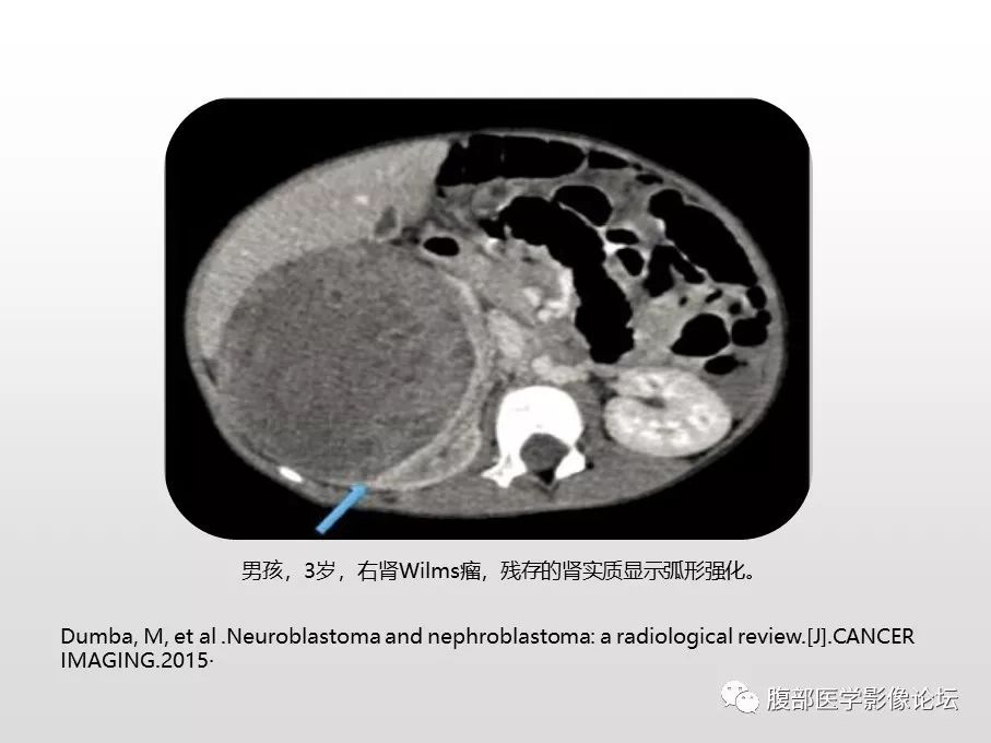 【病例】肾透明细胞肉瘤1例影像表现