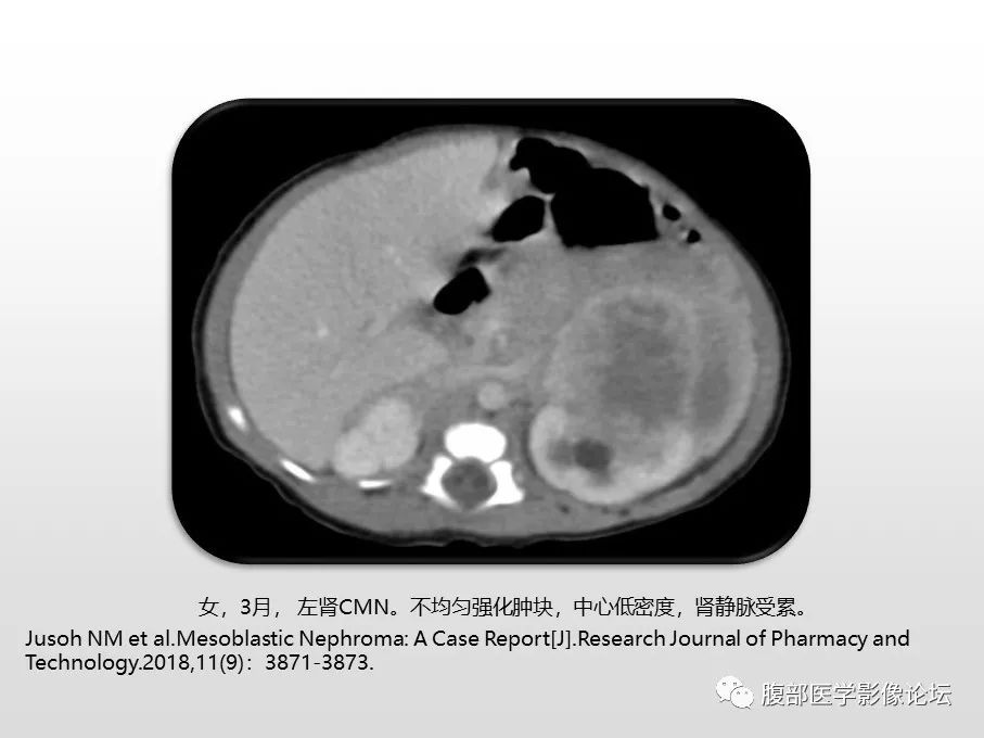 【病例】肾透明细胞肉瘤1例影像表现