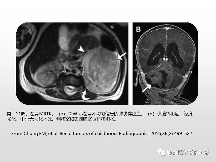 【病例】肾透明细胞肉瘤1例影像表现