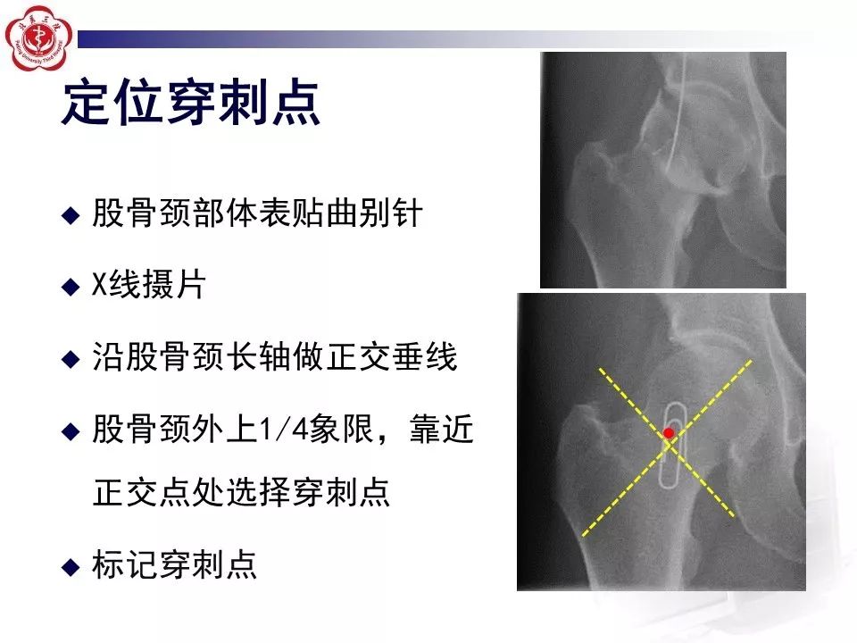 【PPT】髋关节MR造影方法