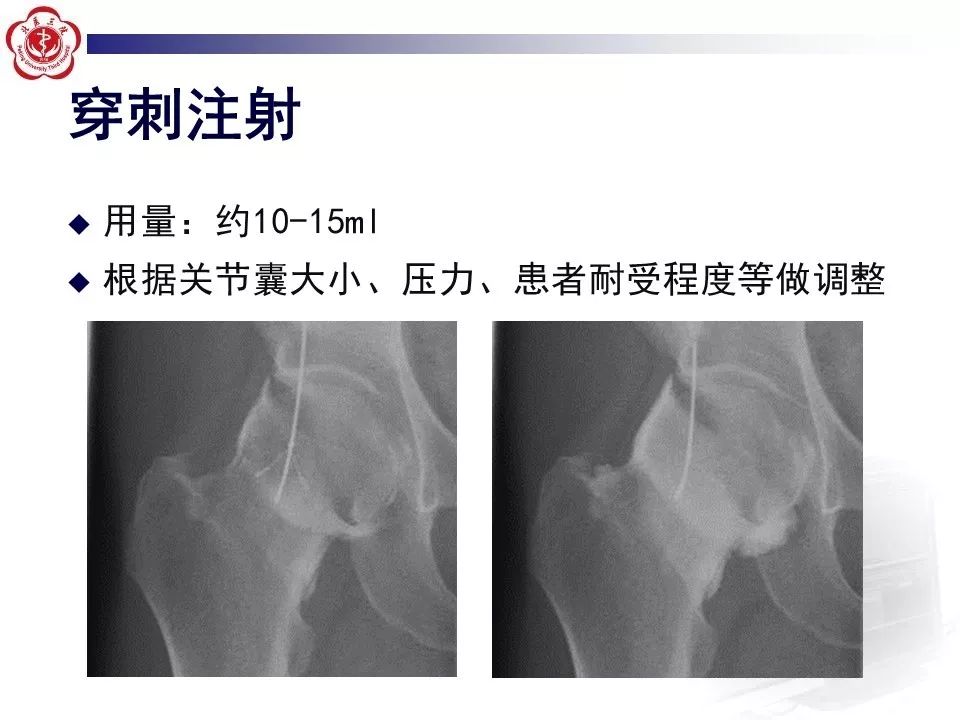 【PPT】髋关节MR造影方法