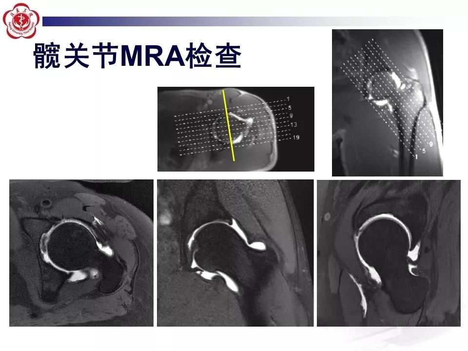 【PPT】髋关节MR造影方法