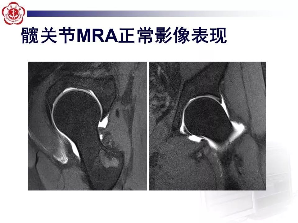 【PPT】髋关节MR造影方法