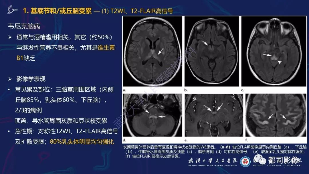 【PPT】中毒性及代谢性脑病影像诊断