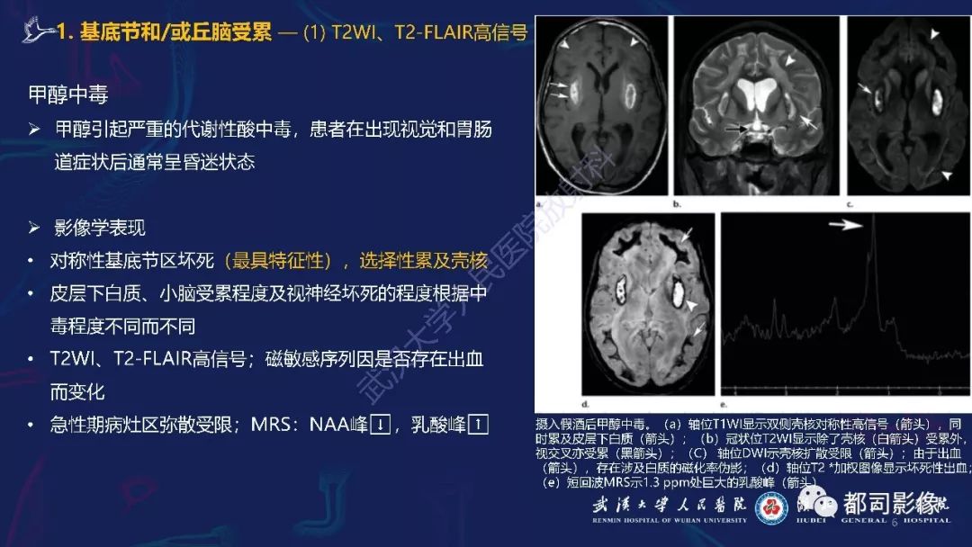 【PPT】中毒性及代谢性脑病影像诊断