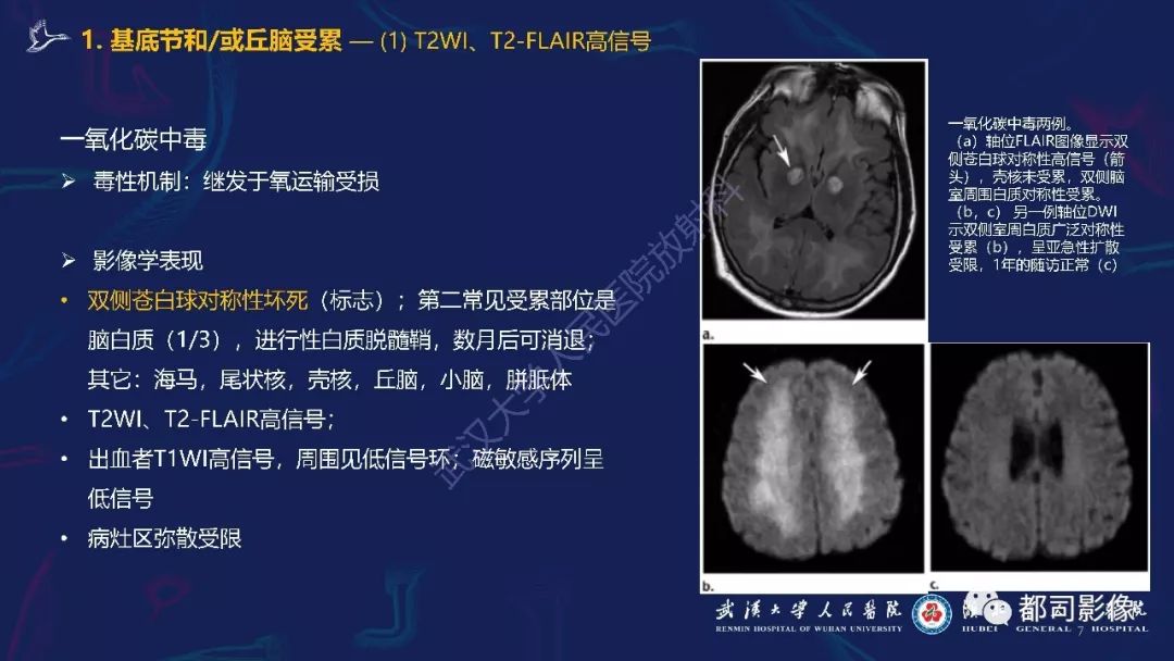 【PPT】中毒性及代谢性脑病影像诊断