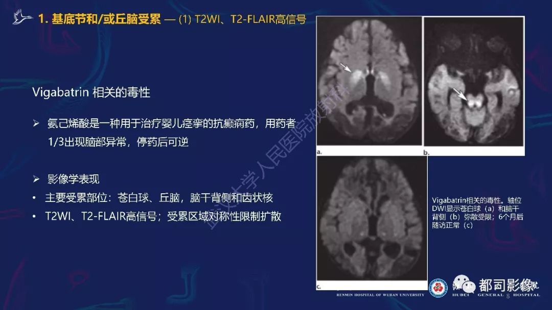【PPT】中毒性及代谢性脑病影像诊断