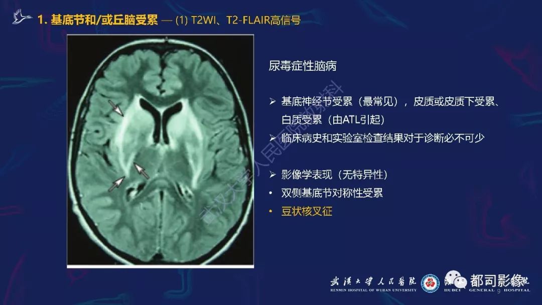【PPT】中毒性及代谢性脑病影像诊断