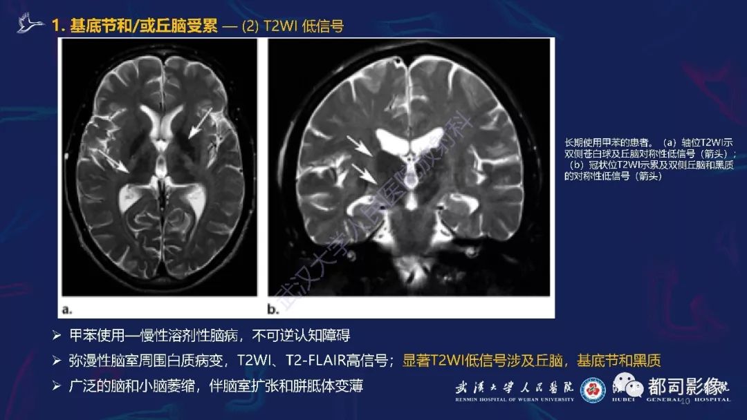【PPT】中毒性及代谢性脑病影像诊断