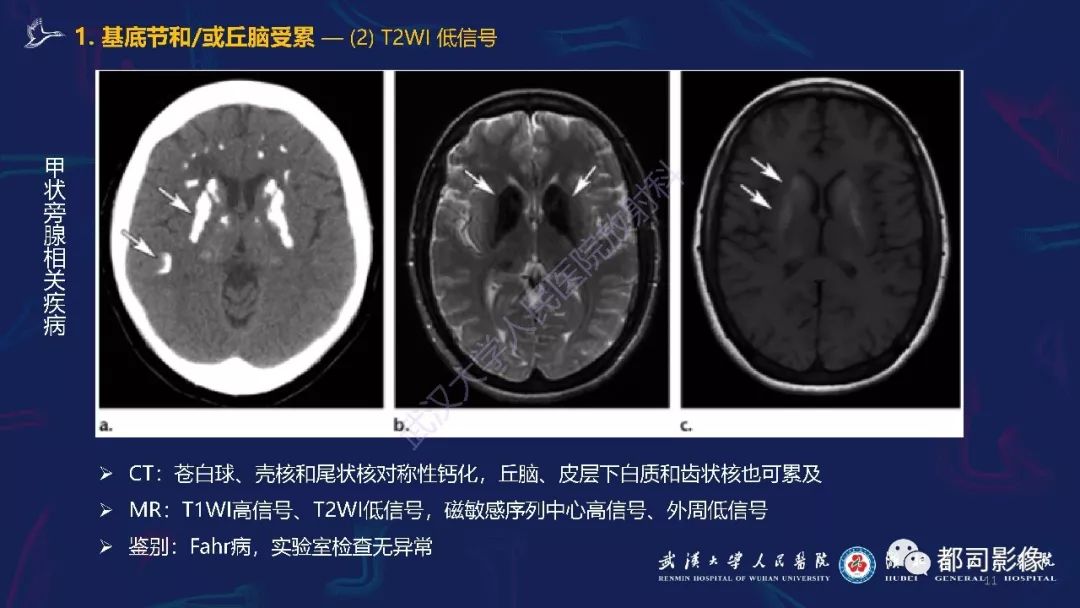 【PPT】中毒性及代谢性脑病影像诊断