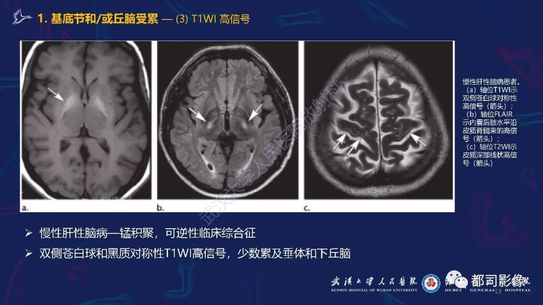 【PPT】中毒性及代谢性脑病影像诊断