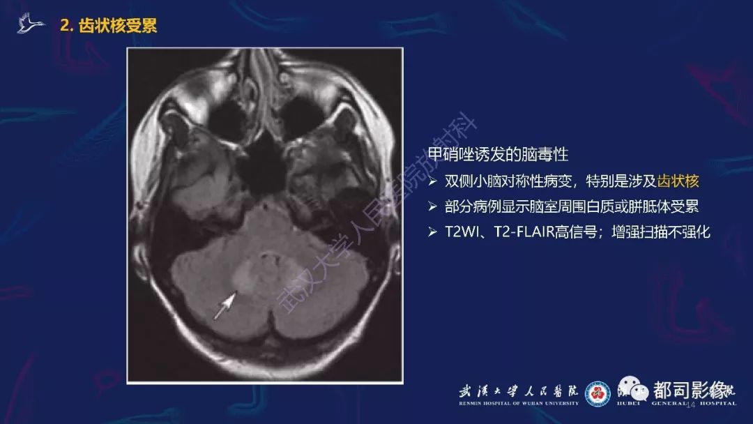 【PPT】中毒性及代谢性脑病影像诊断