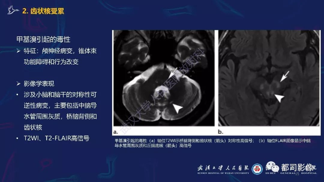【PPT】中毒性及代谢性脑病影像诊断
