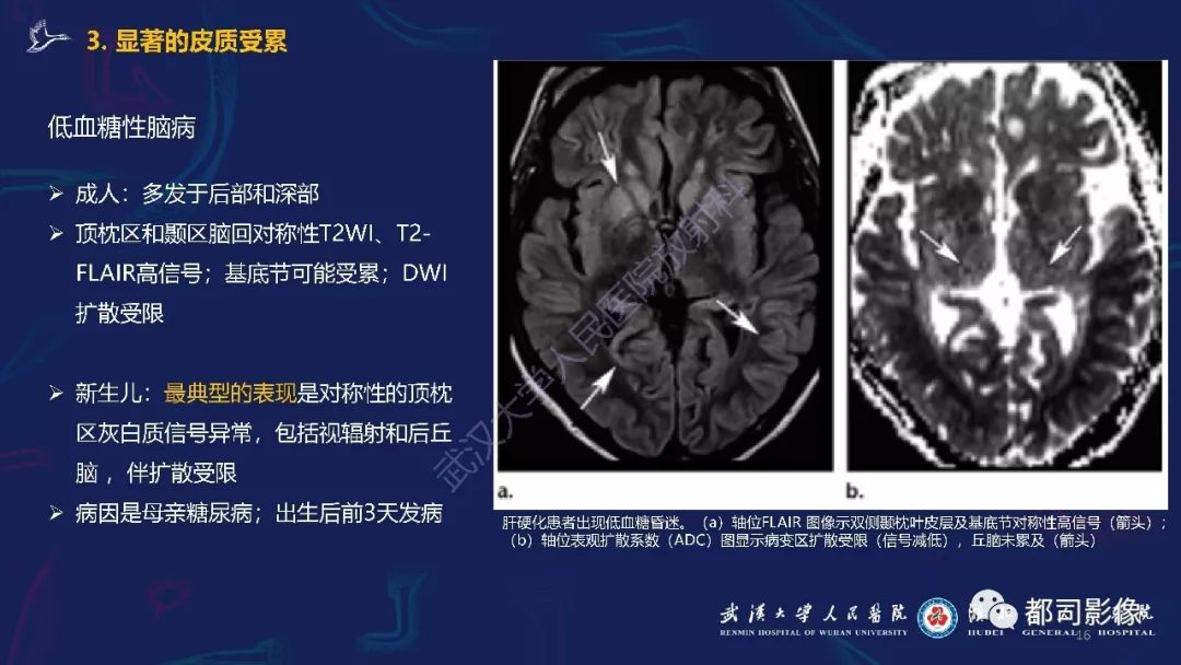 【PPT】中毒性及代谢性脑病影像诊断