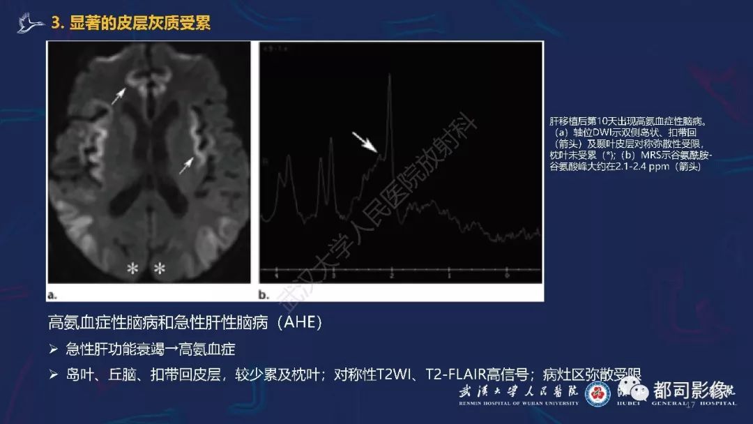 【PPT】中毒性及代谢性脑病影像诊断