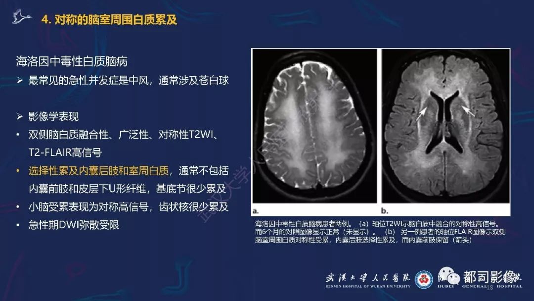 【PPT】中毒性及代谢性脑病影像诊断