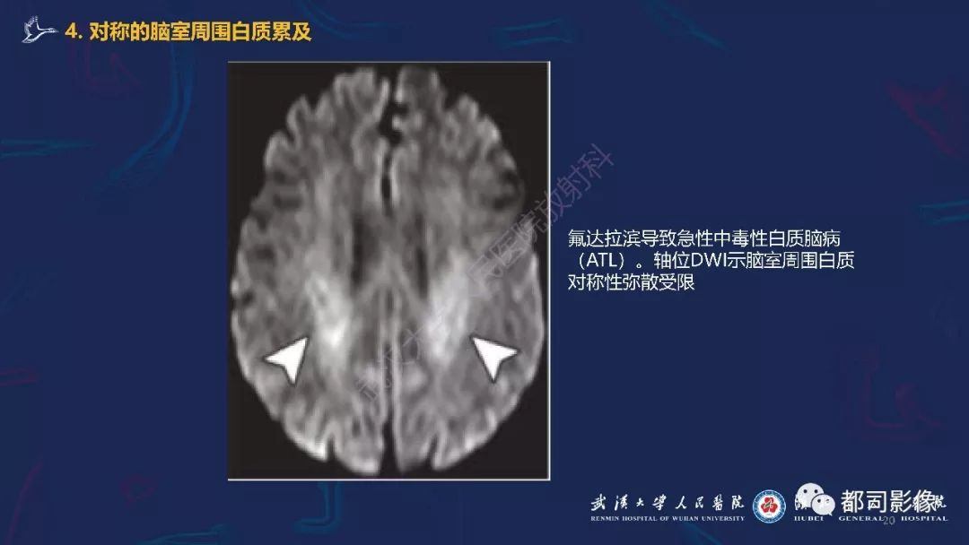 【PPT】中毒性及代谢性脑病影像诊断