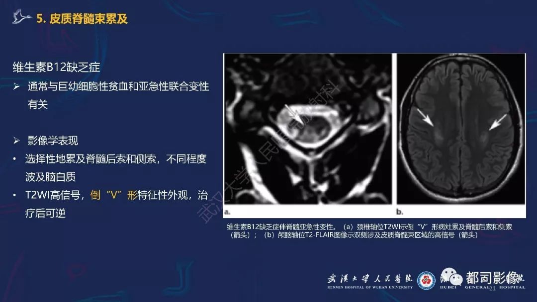 【PPT】中毒性及代谢性脑病影像诊断