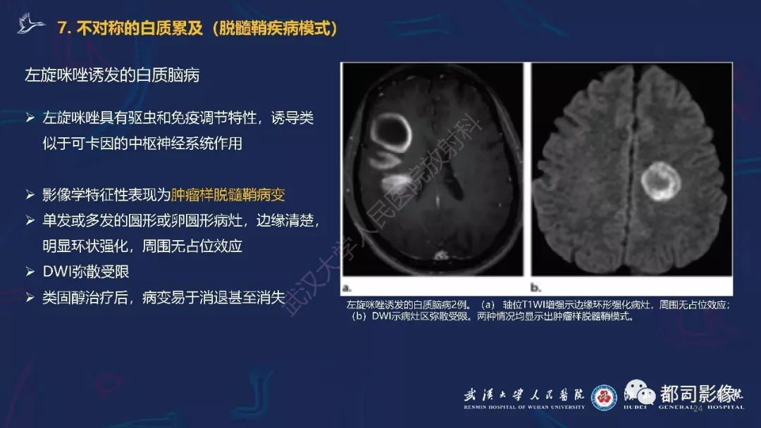 【PPT】中毒性及代谢性脑病影像诊断