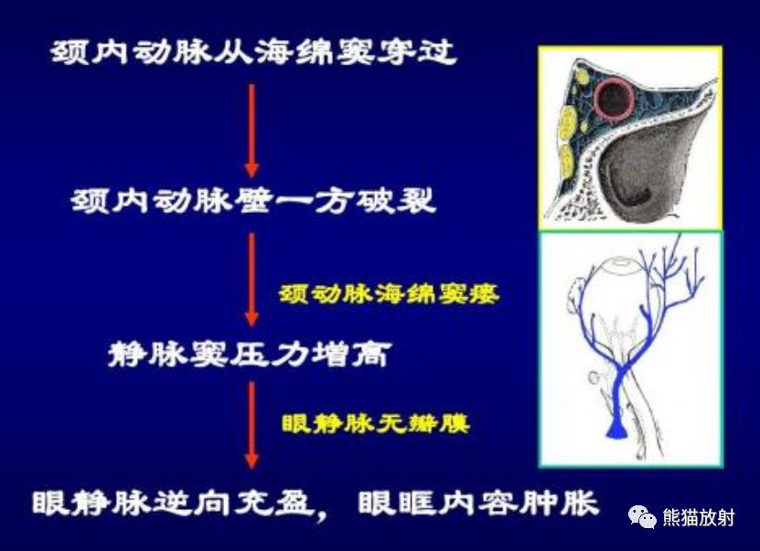 【病例】颈内动脉海绵窦瘘1例CT影像 【病例】颈内动脉海绵窦瘘1例CT影像