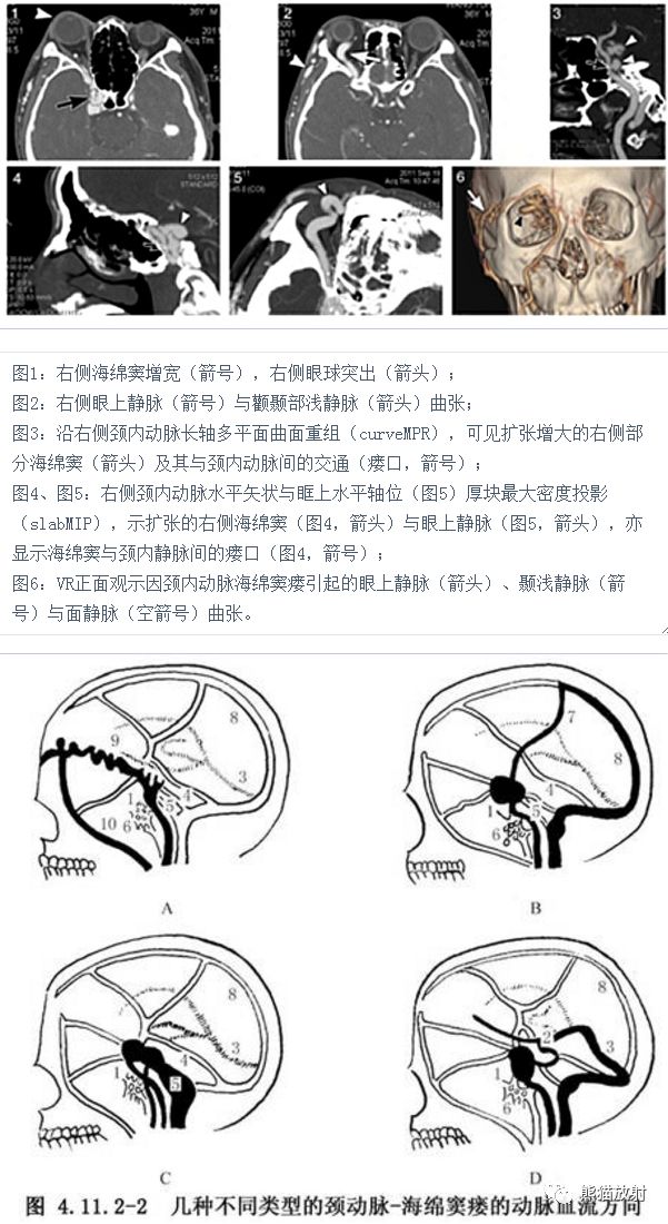 【病例】颈内动脉海绵窦瘘1例CT影像 【病例】颈内动脉海绵窦瘘1例CT影像