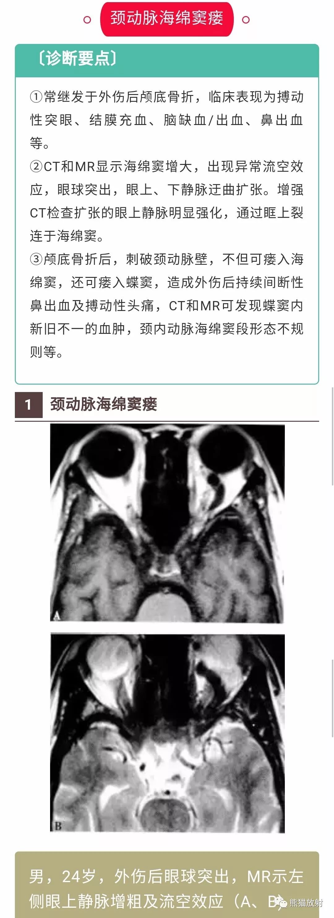 【病例】颈内动脉海绵窦瘘1例CT影像 【病例】颈内动脉海绵窦瘘1例CT影像