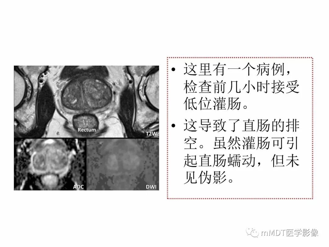 【PPT】前列腺癌：影像报告与数据系统（版本2）