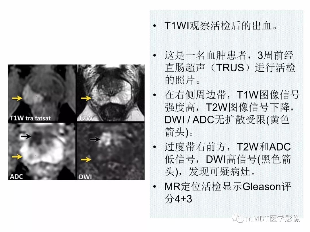 【PPT】前列腺癌：影像报告与数据系统（版本2）