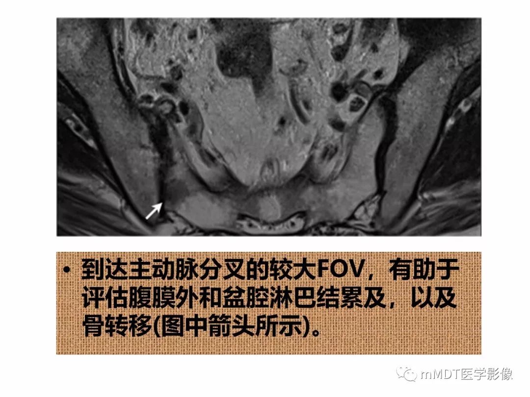 【PPT】前列腺癌：影像报告与数据系统（版本2）