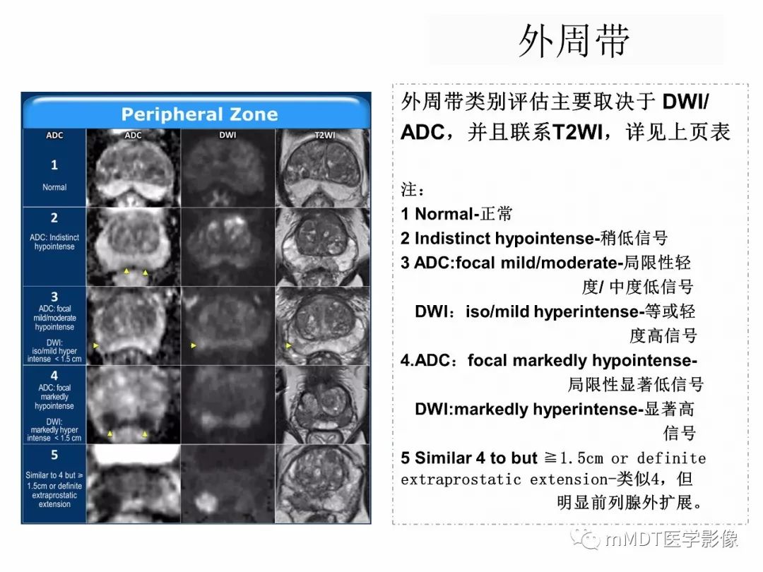【PPT】前列腺癌：影像报告与数据系统（版本2）