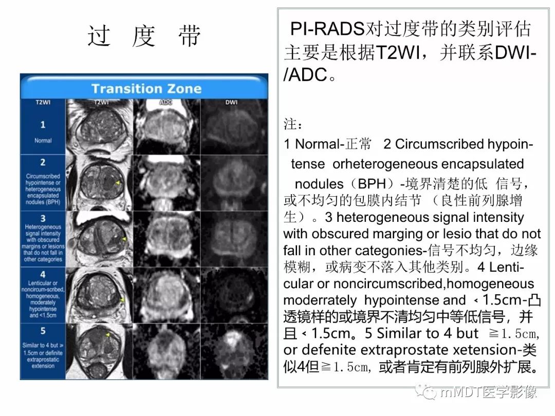 【PPT】前列腺癌：影像报告与数据系统（版本2）