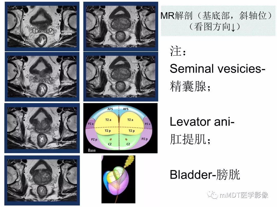 【PPT】前列腺癌：影像报告与数据系统（版本2）