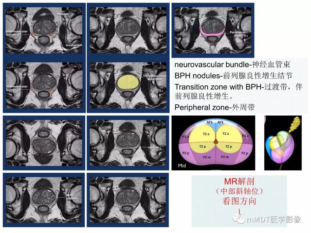 【PPT】前列腺癌：影像报告与数据系统（版本2）