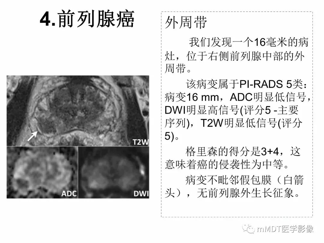 【PPT】前列腺癌：影像报告与数据系统（版本2）