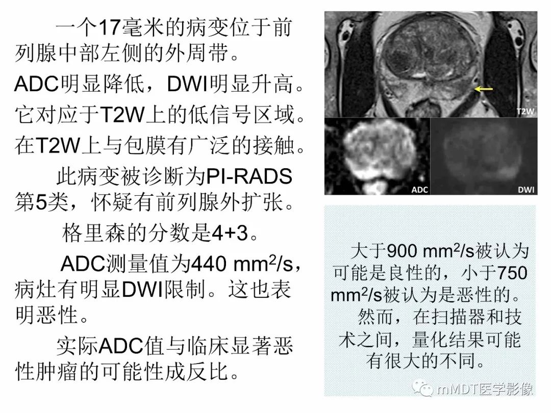 【PPT】前列腺癌：影像报告与数据系统（版本2）