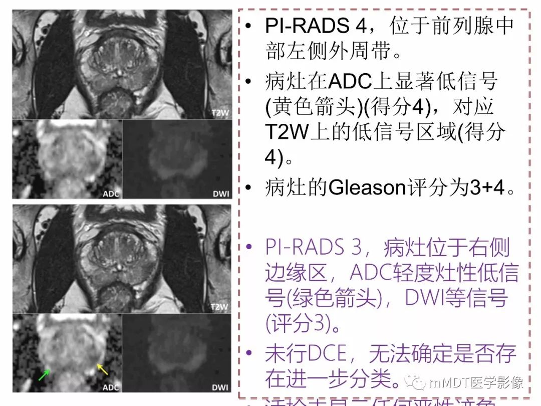 【PPT】前列腺癌：影像报告与数据系统（版本2）