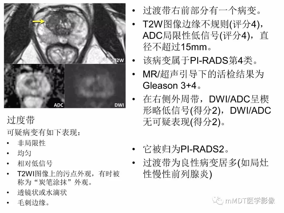 【PPT】前列腺癌：影像报告与数据系统（版本2）