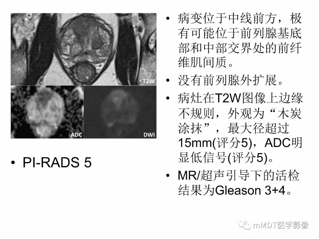 【PPT】前列腺癌：影像报告与数据系统（版本2）