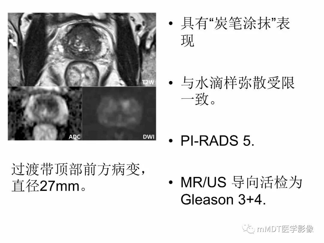 【PPT】前列腺癌：影像报告与数据系统（版本2）
