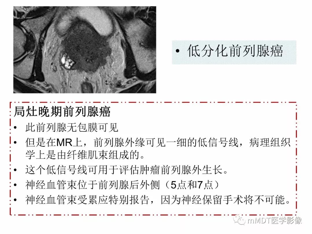 【PPT】前列腺癌：影像报告与数据系统（版本2）