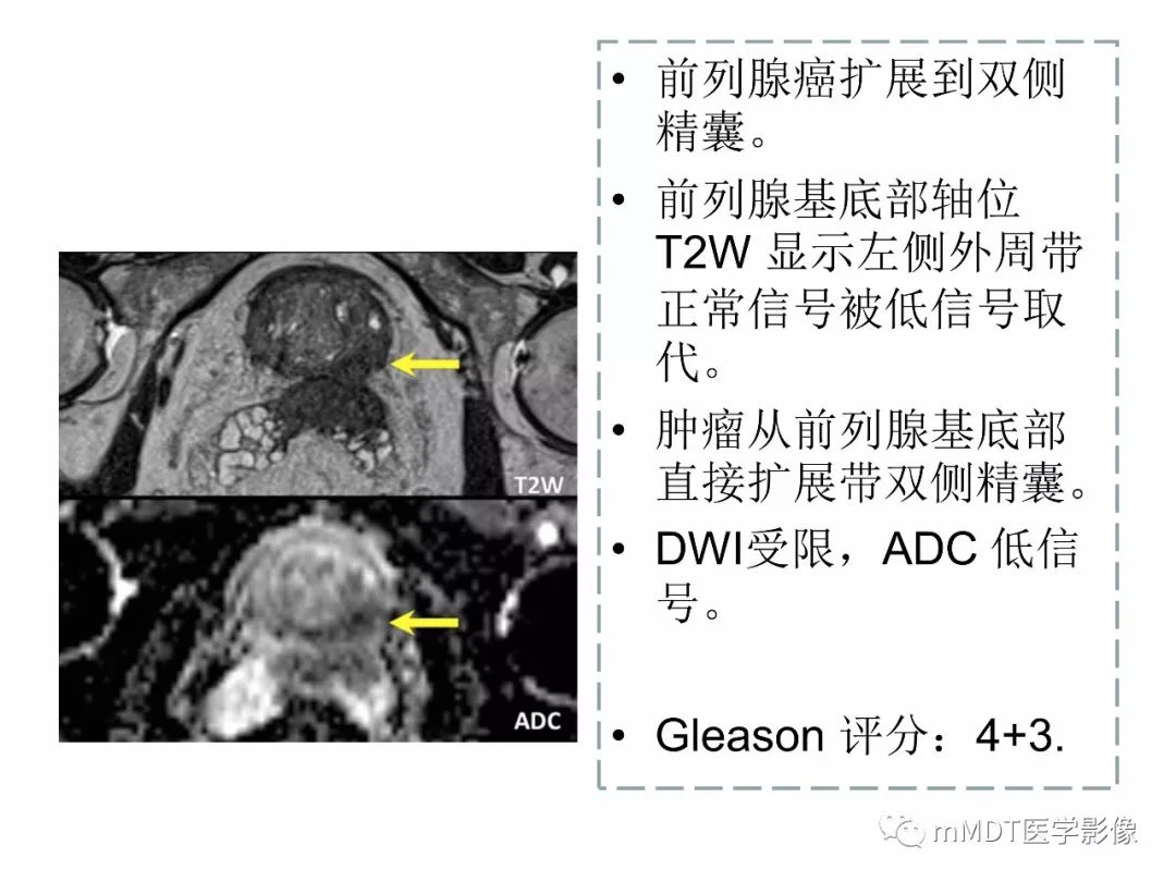 【PPT】前列腺癌：影像报告与数据系统（版本2）