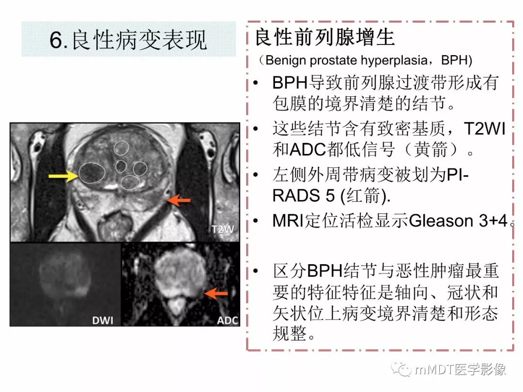 【PPT】前列腺癌：影像报告与数据系统（版本2）