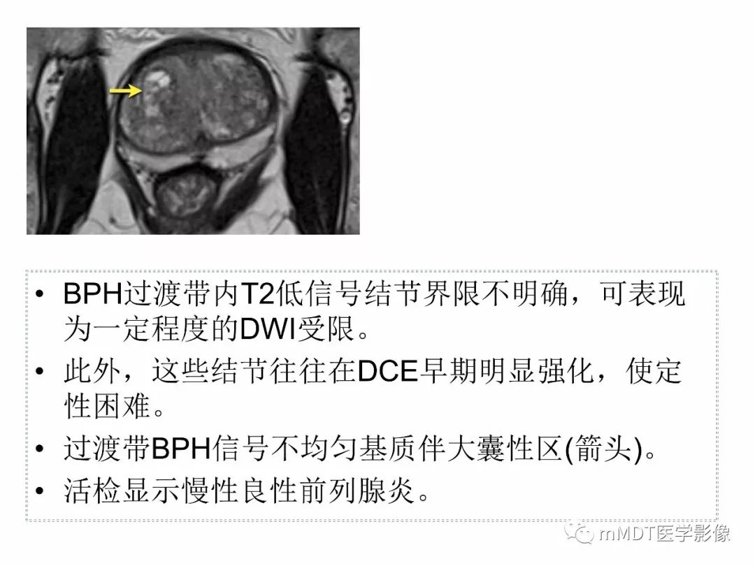 【PPT】前列腺癌：影像报告与数据系统（版本2）