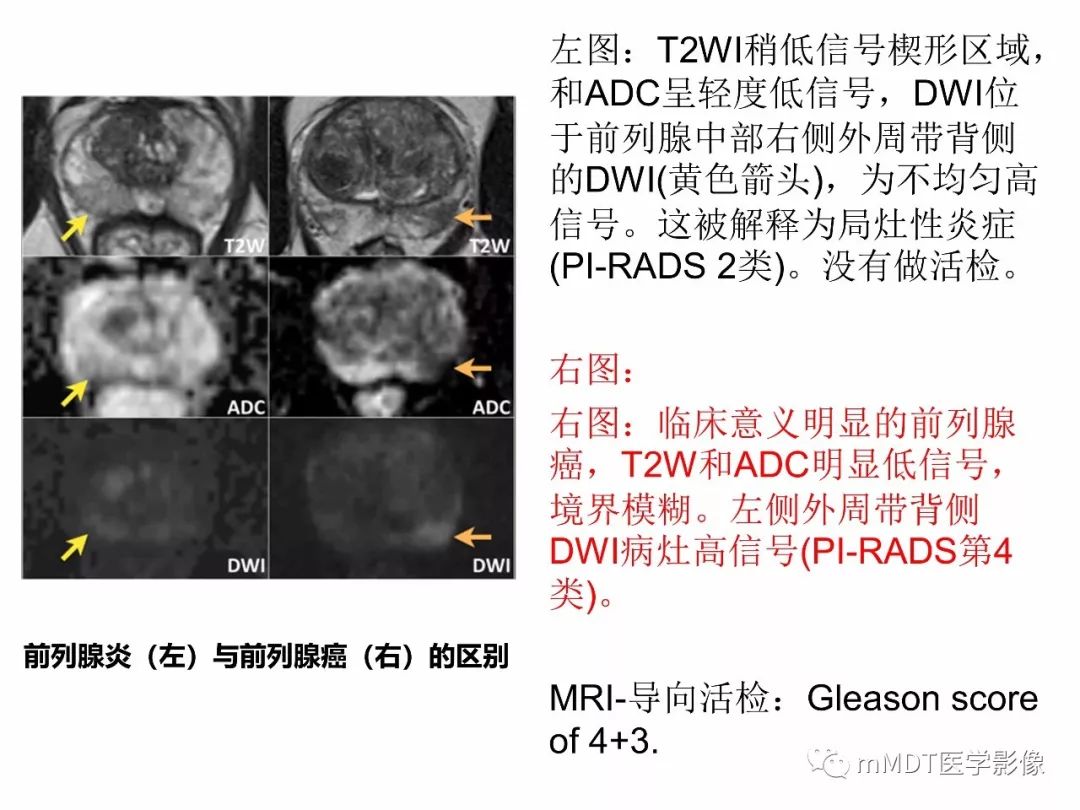【PPT】前列腺癌：影像报告与数据系统（版本2）